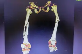 男子腿部三处粉碎性骨折，还都是主要承重骨，到底该咋修复？图片