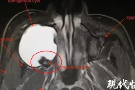 女子牙疼两个月，竟是智齿长到了眼眶下图片