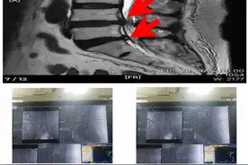 一针解决两段腰椎痛苦 哈医大四院骨科一病房低温等离子射频消融术治疗腰椎间盘突出图片