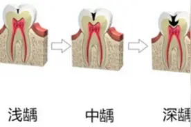 科普口腔｜“蛀牙”是如何形成的？如何预防“蛀牙”？图片