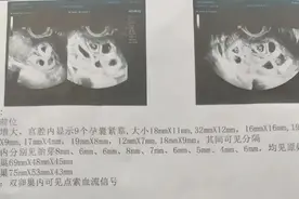 怀九胞胎女子，最终留下两胎图片
