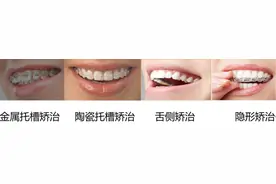 药物警戒·科普站｜牙齿矫正——带您了解牙套图片