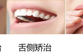 药物警戒·科普站｜牙齿矫正——带您了解牙套图片