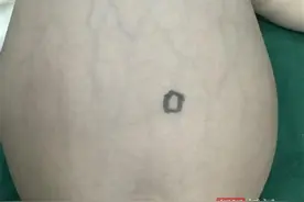 男婴肚里藏4斤重的“西瓜”，瘤内还有皮肤和头发，医生：畸胎瘤并非被“吃掉”的双胞胎图片