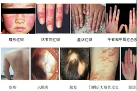 与“狼”共舞，系统性红斑狼疮日常护理指南，一文掌握！图片