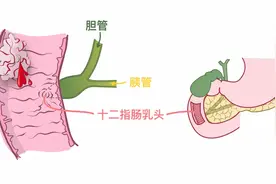 “黑便”背后藏危机，中山医院多学科“双镜合璧”巧拆瘤图片
