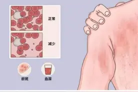 孩子为什么会莫名其妙出现大块淤青斑？图片