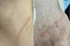 小心“飞行的硫酸” 专科医生：遇到此类虫子切勿用手拍打图片