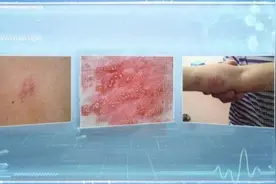 揉眼睛感染病毒！原因竟是——图片