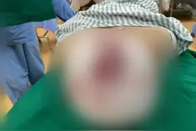 想想都痛！女子长发卷入机器，头皮被整片撕脱……广州医护及时出手→图片