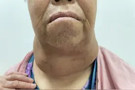 五十年甲状腺肿折磨终得解 北京友谊医院高难度手术为患者除病痛图片