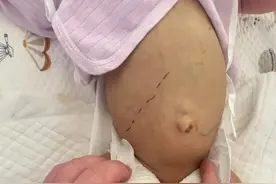 警惕婴儿胆汁淤积症 青岛妇儿医院与复旦儿科医院远程连线制定诊疗方案图片
