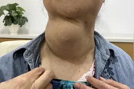 妙手摘11公分“巨弹”！甲状腺结节疯长压扁气管，太险了……图片