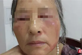 近期已接诊多例！医生提醒：这种虫子不能打图片