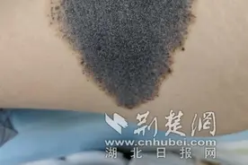 23岁女孩告别“兽皮痣” 医生妙手重塑美丽肌肤图片