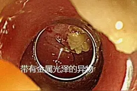 老人突发高烧39℃ 拍胸片意外发现鱼钩图片