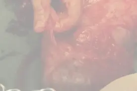 罕见！福建一女子，生下个“蛋壳宝宝”！图片