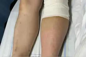男子乘坐长途飞机后成了“大象腿”，竟被确诊为这种病图片