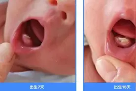 出生15天，就长了2颗牙？图片