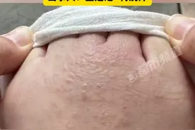 头皮发麻！女子试完鞋后瘙痒难耐，密密麻麻全是……很多人有类似经历图片