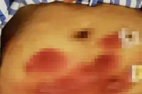 女网红为变美注射“减脂神器”，全身感染进医院！一掀衣服令人崩溃……图片
