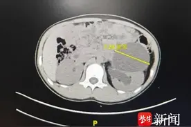 12岁女孩经常腹痛，一查竟然长了3根输尿管图片