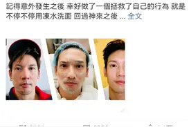 突遭意外！知名男演员面部二级烧伤图片