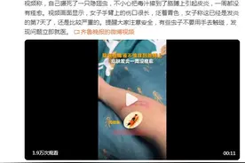 女子胳膊沾到隐翅虫毒液引起发炎，一周都没痊愈图片