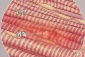 【垂医科普】肾内科：横纹肌溶解症 了解一下？图片