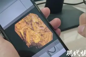 91岁奶奶胆总管长出8厘米结石，医生历时三个月全取出图片