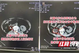 女子右腰偶有胀痛误以为劳累所致 不料真凶竟是颗黄豆大结石图片