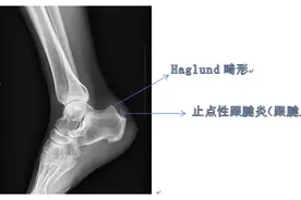 一男子脚跟疼，竟被医生告知“钙化”图片