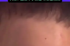 狗尾草点痣可行吗？专家：跟风模仿有风险图片