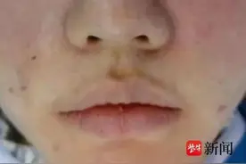 注射“胶原蛋白”后她“烂脸”了……美容变“毁容”图片