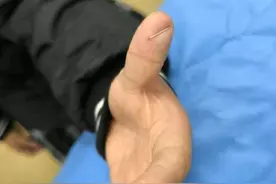 疼！孩子寒假在家一定要小心！医生提醒：这类意外创伤要及时就医！图片