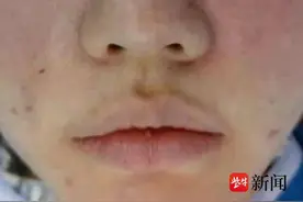 注射“胶原蛋白”后她“烂脸”了……为何美容竟变“毁容”？图片