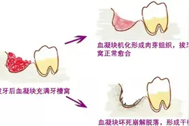 女子嘴里发出粪便般腐臭，原来是干槽症...图片