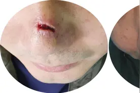 听算命先生的话男子点了痣，结果只能长期戴着口罩……专家帮他恢复正常生活图片