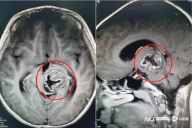 视物重影致小朋友考试时漏题、漏行，根源竟是这种良性脑瘤图片