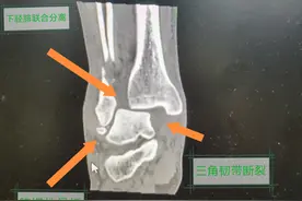 男子一次崴脚折断三处脚骨，原来韧带早已撕裂图片