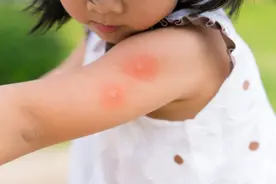 挠痒预警！秋后蚊子猛如虎！为什么蚊子包还分小号、中号、大号？图片