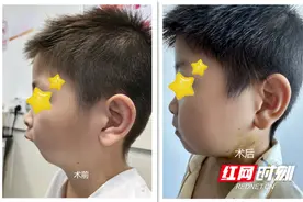幼童下颌畸形呈“鸟状”面容 湖南省儿童医院手术再造下巴图片
