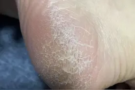 脚后跟开裂的真凶，可能是这3种大病！别以为只是太干燥了！图片