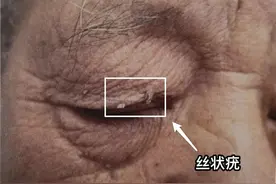 丝状疣需要治疗吗？不治疗有什么后果？图片