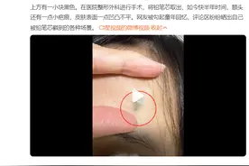 杭州8岁男孩一不小心把铅笔芯扎进……网友：我也有过！图片
