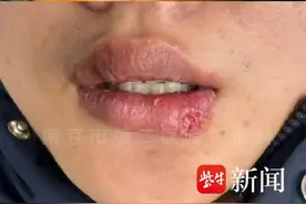 吓人！男子与爱宠“亲亲”，半个嘴唇被咬掉！图片
