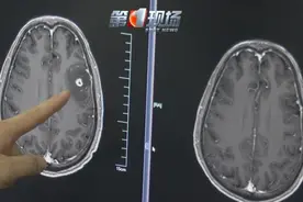 六旬大爷头疼头晕，一查脑袋爬满“虫”！图片