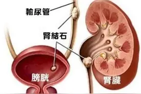 合理饮食预防泌尿结石图片