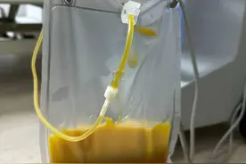 外卖、火锅、夜宵长期“炫”，90后小伙血液里抽出500ml“油”！医生提醒→图片