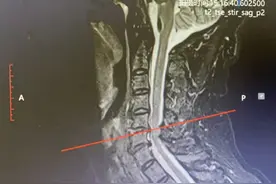“零切迹”治疗脊髓型颈椎病，最严重颈椎病能微创治疗了图片